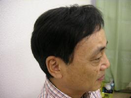 熱い夏を好いたらしいに！涼しさを重視した診療用ウィッグ
