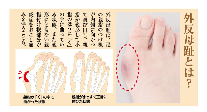 楽天市場 寝ながら外反母趾サポーター 左右組 外反母趾 サポーター テーピング ホームケア フリーサイズ 調整可能 アイネットショップ