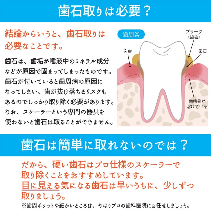 楽天市場 歯石けずり 歯のクリーニングしま専科 歯石取り 歯石けずり 歯石 ステンレス ヤニ取り 歯のようじ キュレット アヌシ アヌシ楽天市場店