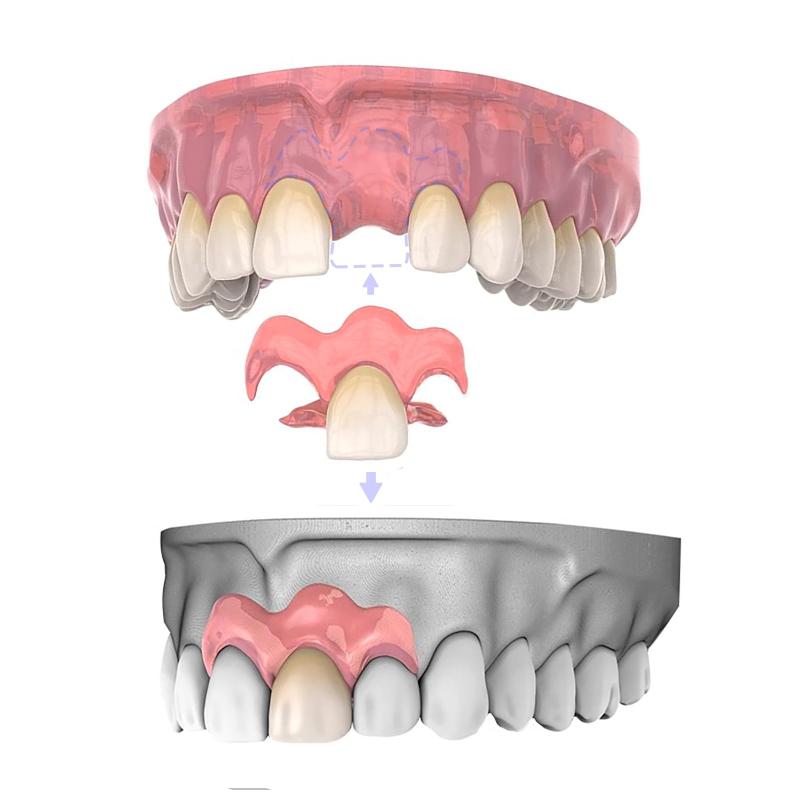 Dentellea 部分義歯分け取り 部分義歯