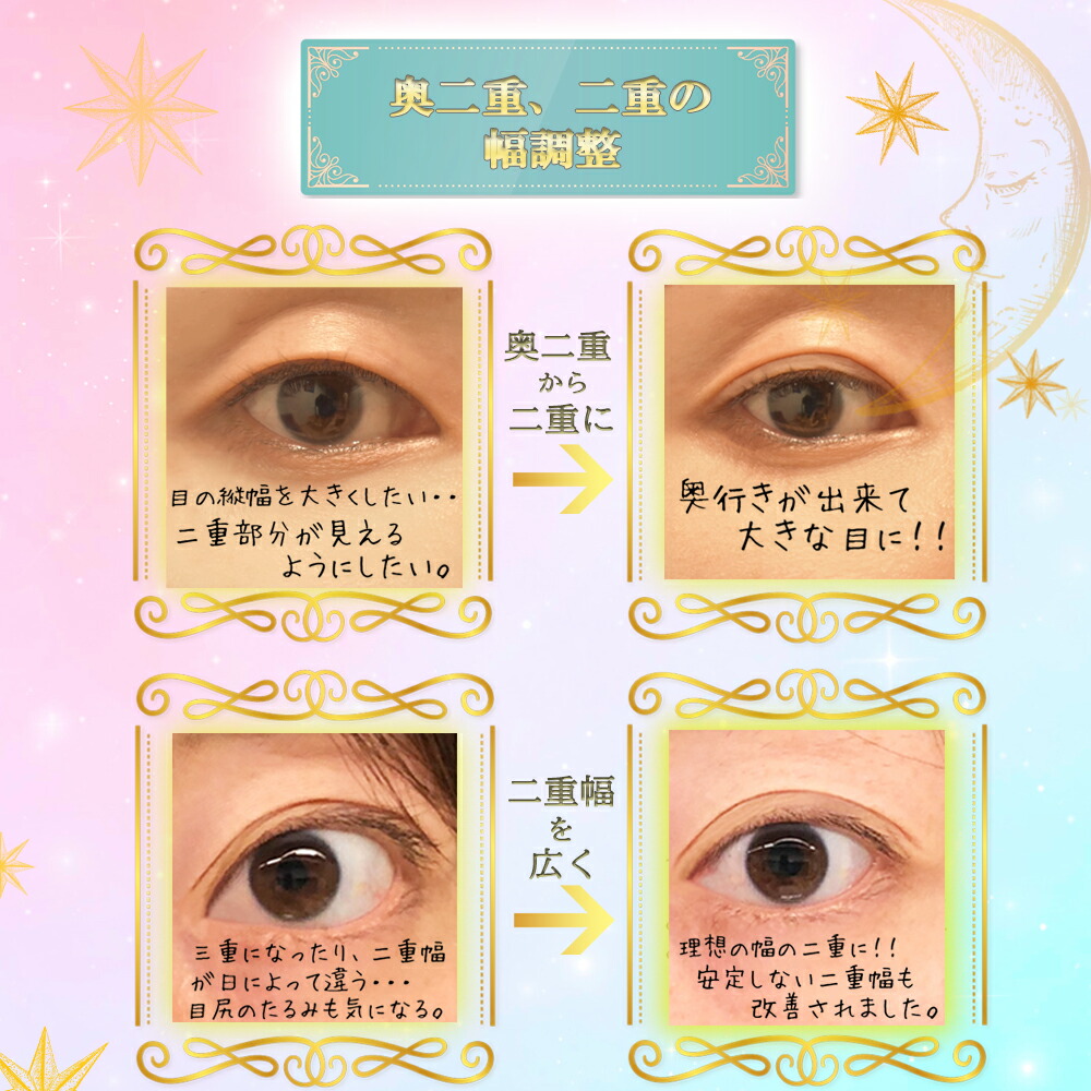 新発売 ばれない二重 ネコポス送料無料 くるりんfutae本舗くっつけない二