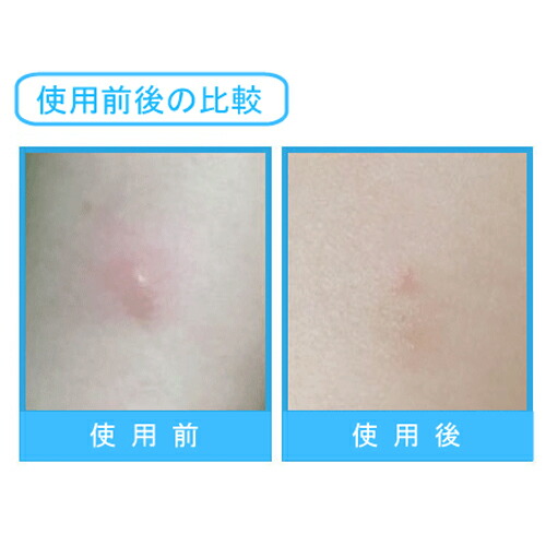 Raphas Japan Acropass Bug Patchアクロパス バグ継 5箱硬化虫さされ パッチ Daemlu Cl