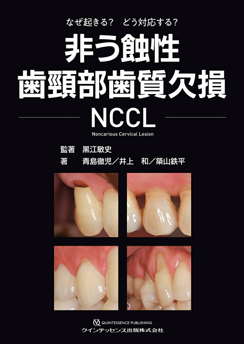 楽天ブックス: 非う蝕性歯頸部歯質欠損 NCCL - なぜ起きる？ どう対応する？ - 黒江敏史 - 9784781210261 : 本