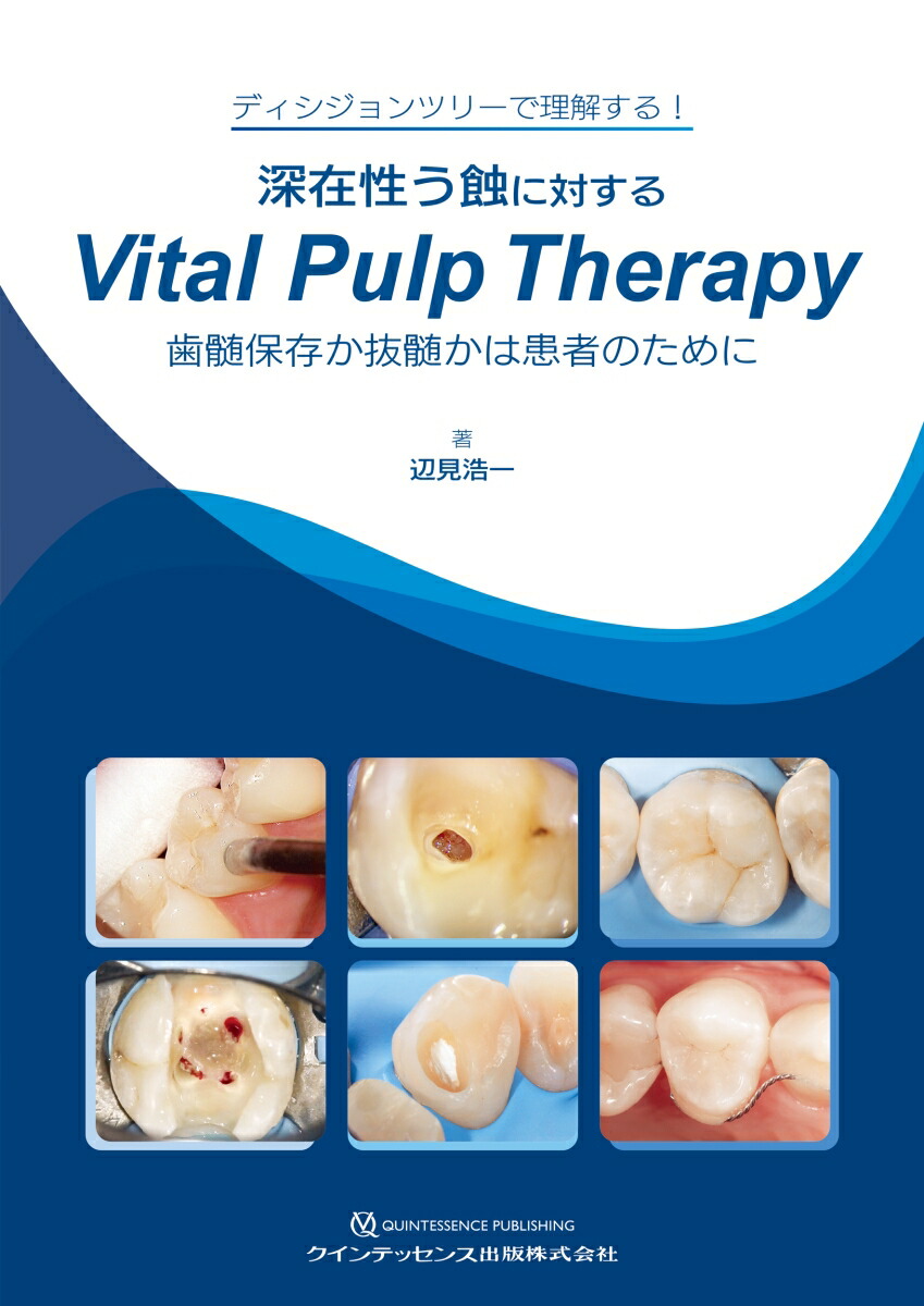 深在性う蝕に対するVital Pulp Therapy画像