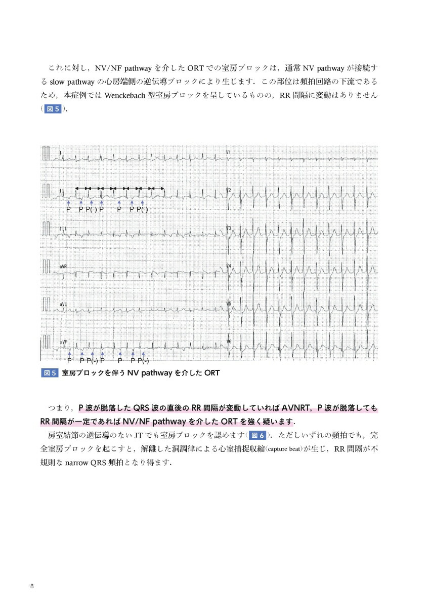 EPSとSVT心臓電気生理学的検査と上室頻拍[永嶋孝一]