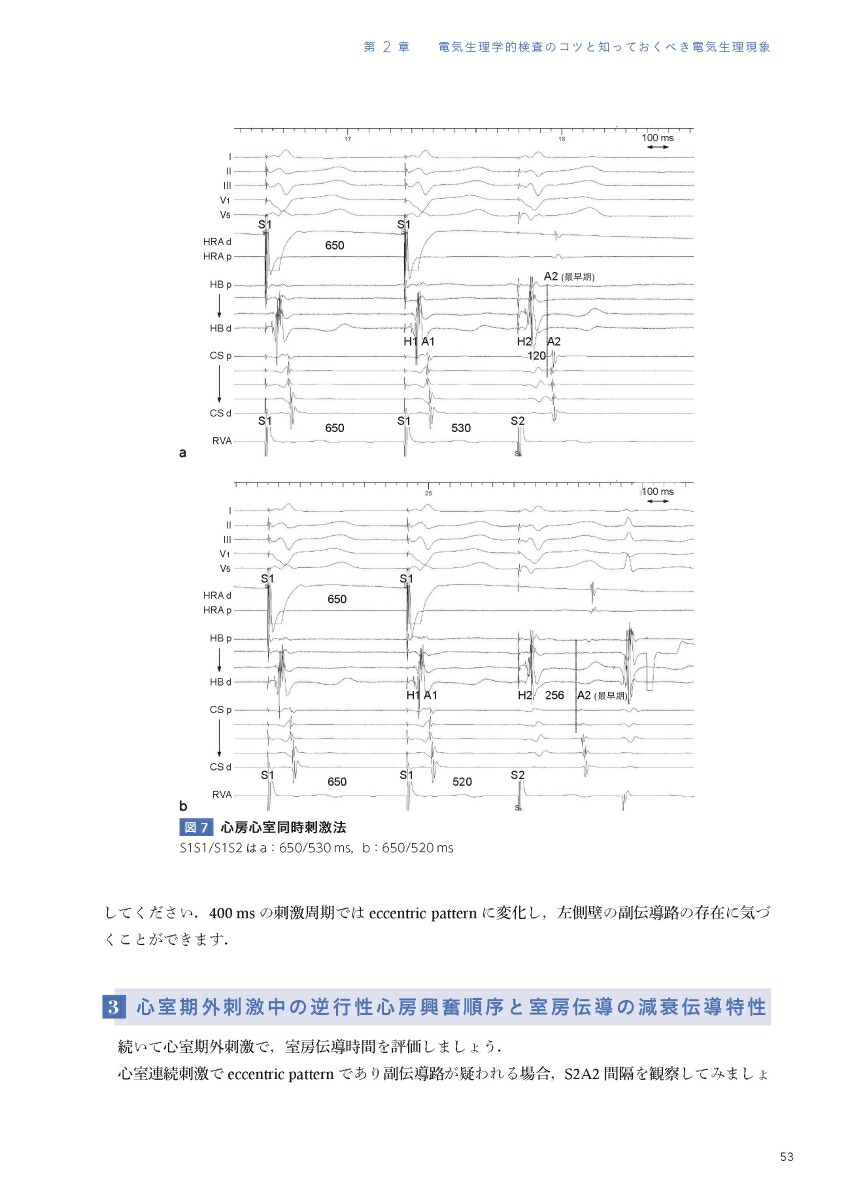 EPSとSVT心臓電気生理学的検査と上室頻拍[永嶋孝一]