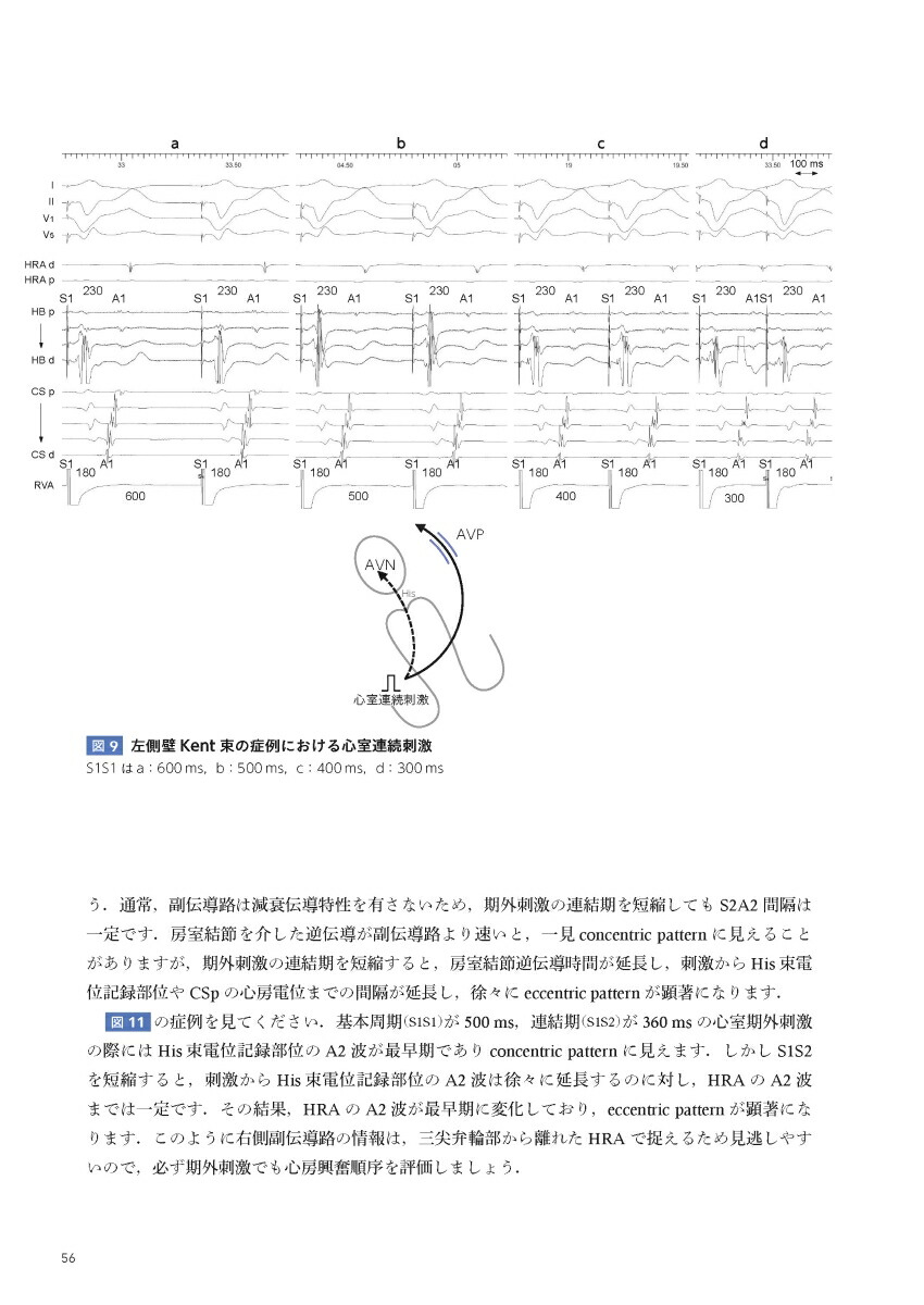 EPSとSVT心臓電気生理学的検査と上室頻拍[永嶋孝一]
