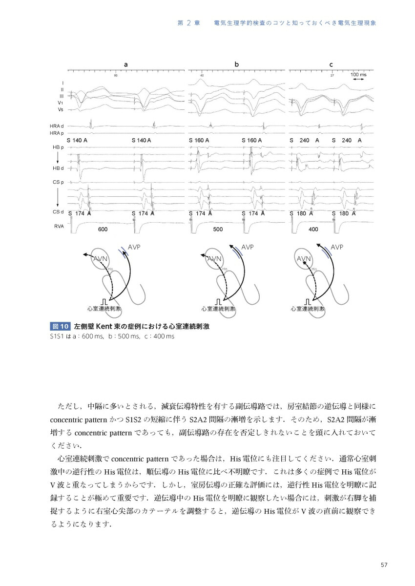 EPSとSVT心臓電気生理学的検査と上室頻拍[永嶋孝一]