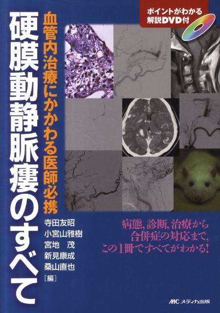 dAVF・AVM（硬膜動静脈瘻・脳動静脈奇形）のすべて：中枢神経系