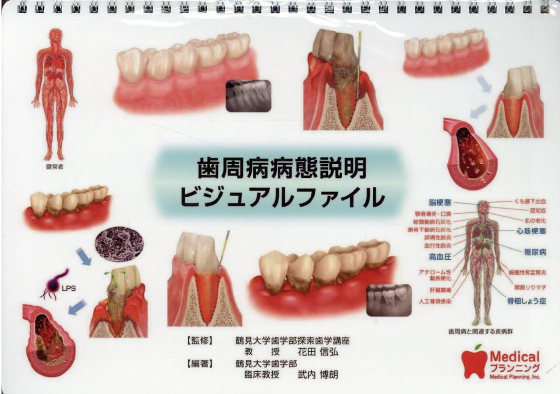 歯周病病態説明ビジュアルファイル