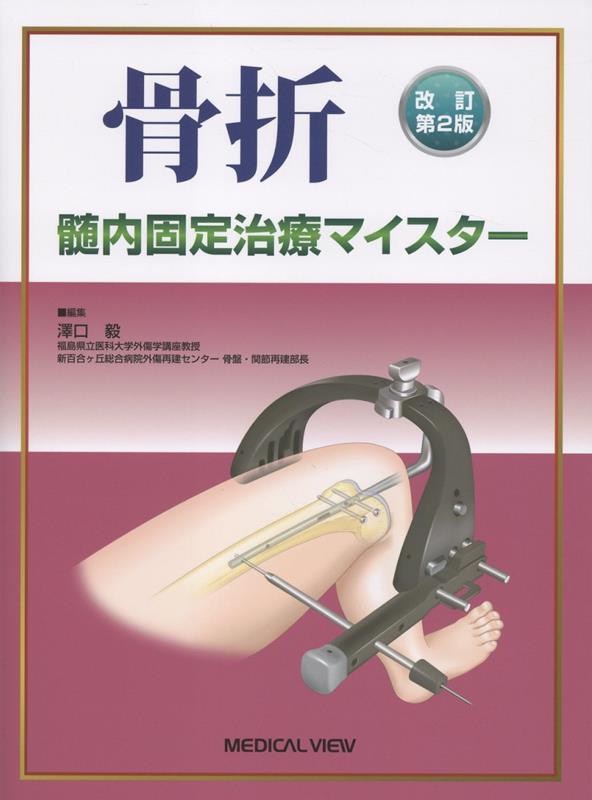 楽天ブックス: 改訂第2版 骨折 髄内固定治療マイスター - 澤口 毅
