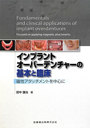 楽天ブックス: インプラントオーバーデンチャーの基本と臨床 - 磁性