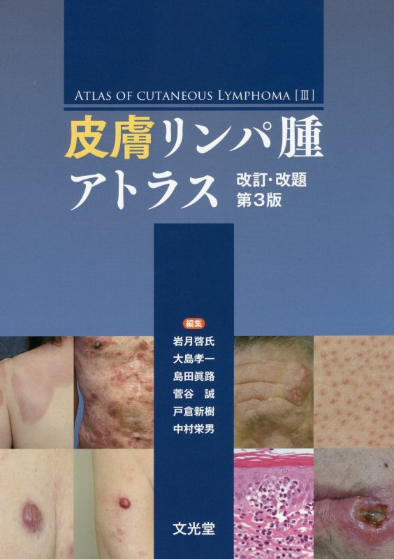 本 皮膚リンパ腫 13 (皮膚科臨床アセット 13) [単行本] 岩月啓氏