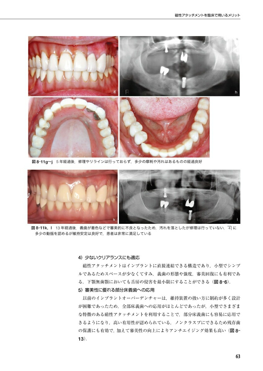 楽天ブックス 新インプラントオーバーデンチャーの基本と臨床 磁性アタッチメントを中心に 田中譲治 本