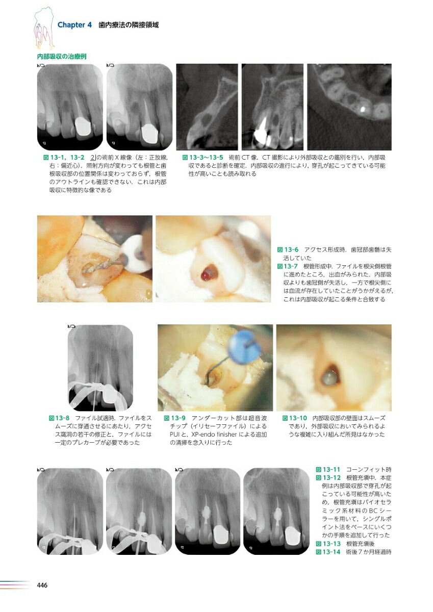 最高級のスーパー世界基準の臨床歯内療法第2版 科学・医学・技術