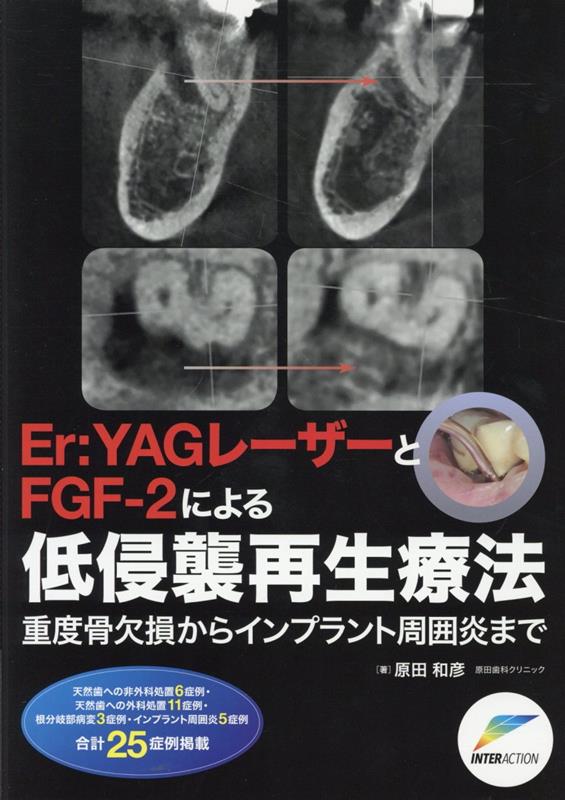 ⚠裁断済　Er: YAGレーザーとFGF-2による低侵襲再生療法 : 重度…　☆ 楽天ブックス: Er：YAGレーザーとFGF-2による低侵襲再生療法 - 原田