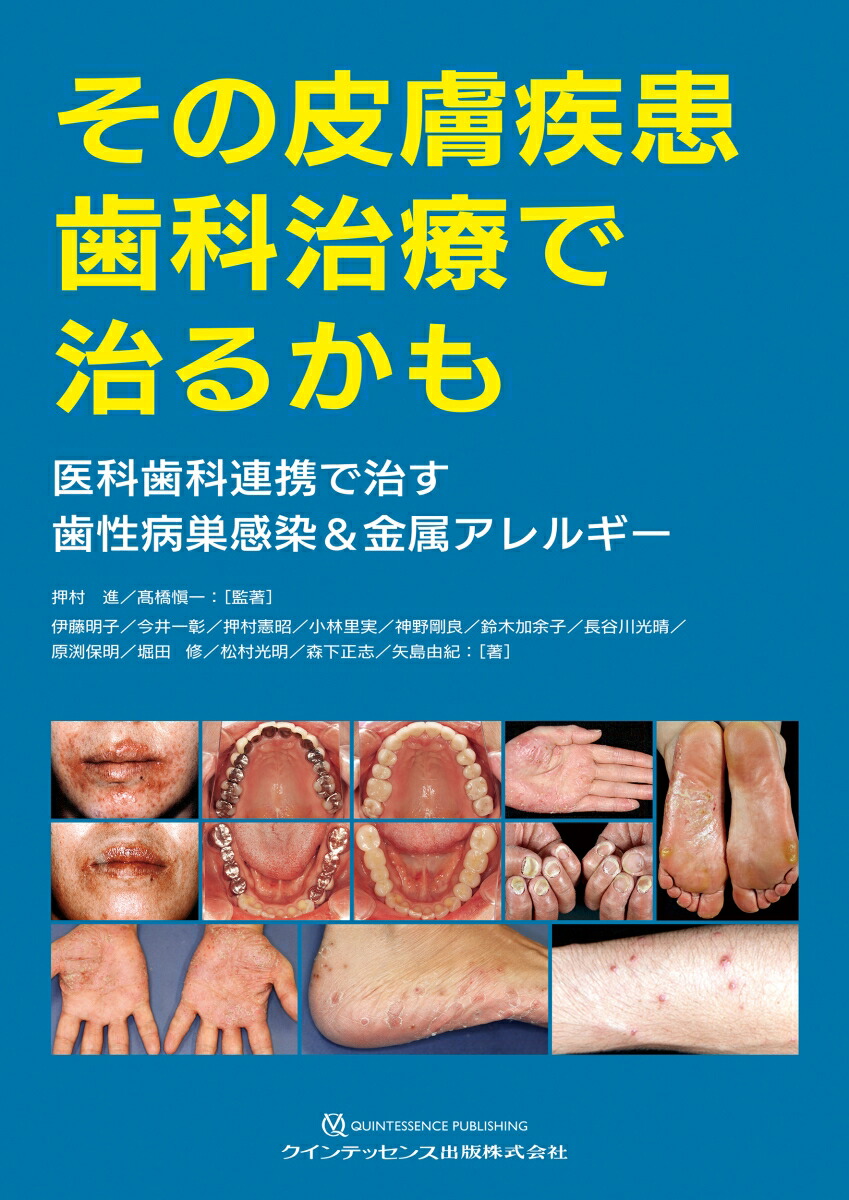 楽天ブックス その皮膚疾患 歯科治療で治るかも 医科歯科連携で治す歯性病巣感染 金属アレルギー 押村 進 本