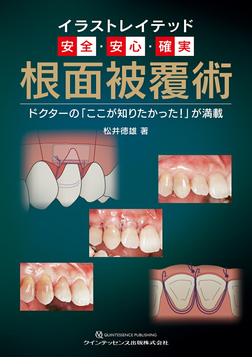 楽天ブックス イラストレイテッド 安全 安心 確実 根面被覆術 ドクターの ここが知りたかった が満載 松井徳雄 本