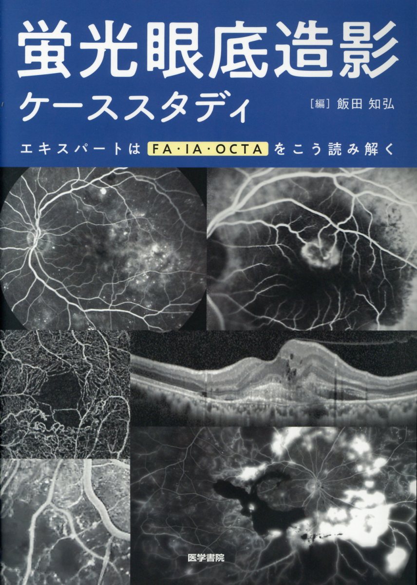 値段が激安 蛍光眼底造影ケーススタディ エキスパートはfa Ia Octaをこう読み解く 驚きの値段で Noudeal Com