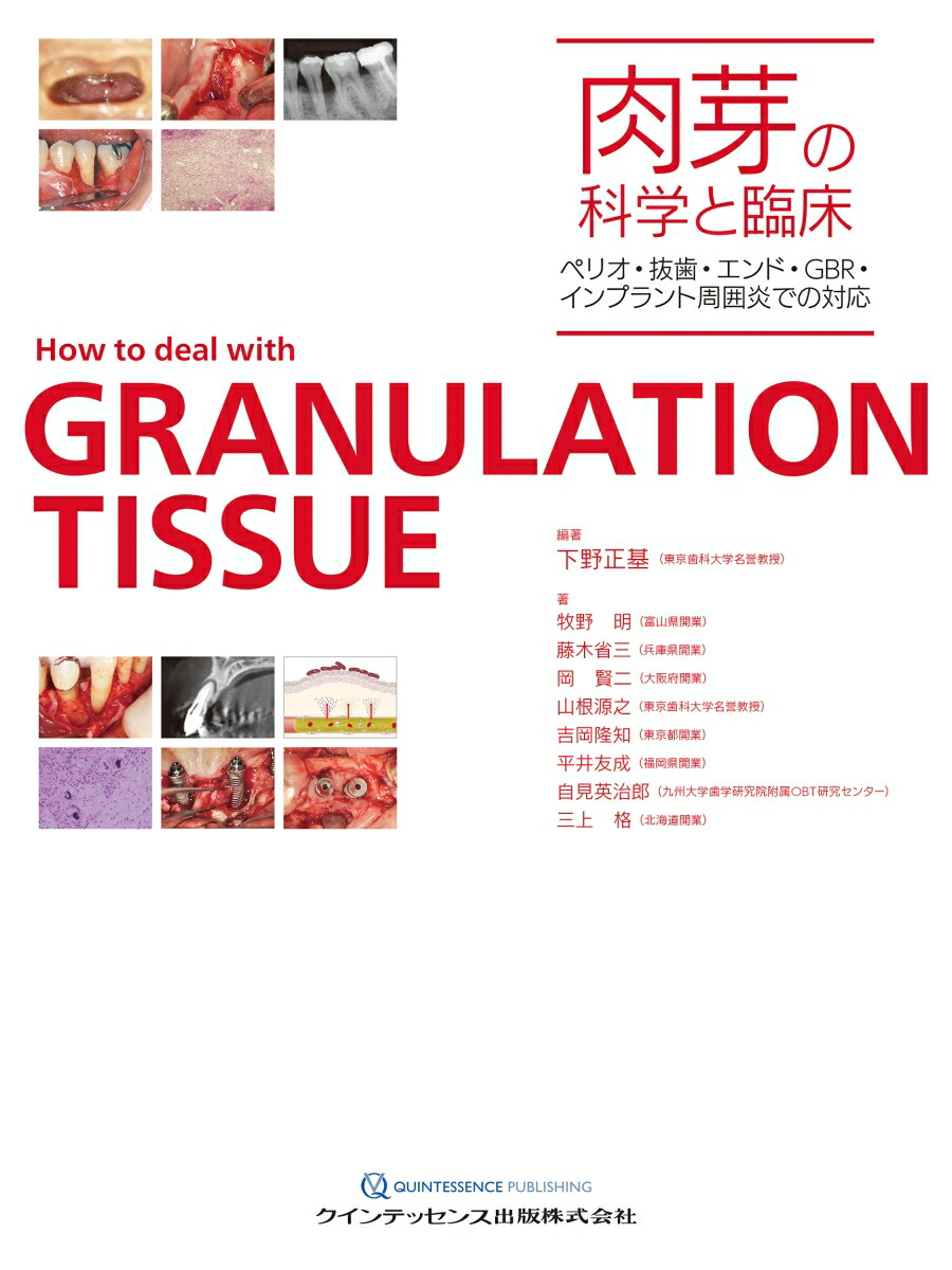 肉芽の科学と臨床 : ぺリオ・抜歯・エンド・GBR・インプラント周囲炎での対応… 楽天ブックス: 肉芽の科学と臨床 - ペリオ・抜歯・エンド・GBR