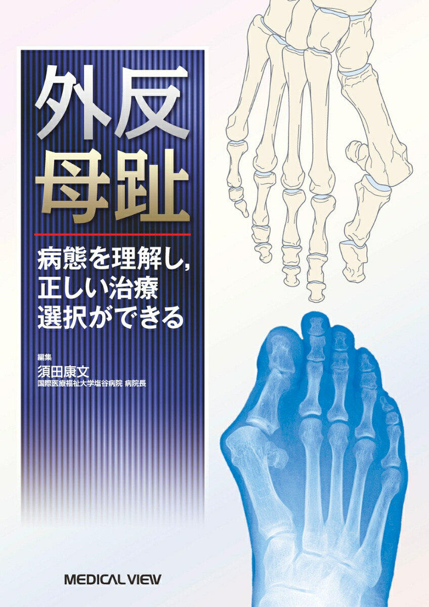 楽天ブックス: 外反母趾 病態を理解し，正しい治療選択ができる - 須田