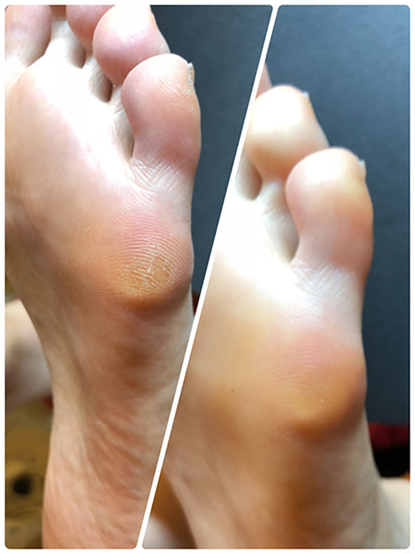 楽天市場 Re Soft リソフト フットケア用角質ケアソフナー 1ml ボディケア フットケア 角質軟化剤 キャラカ