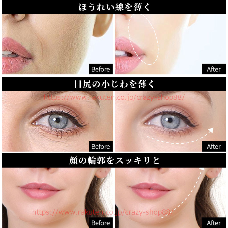Hifu美顔器 家庭用 ハイフ ウルセラ ミニ Hifu 美顔器 RF ラジオ波