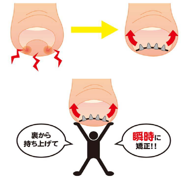 まきづめリフト1個入りフリーサイズML1巻き爪ケアまき爪矯正フリーサイズ巻爪ケア矯正ワイヤー爪やすり付き裏から持ち上げ瞬時に矯正一般医療機器DM便送料無料