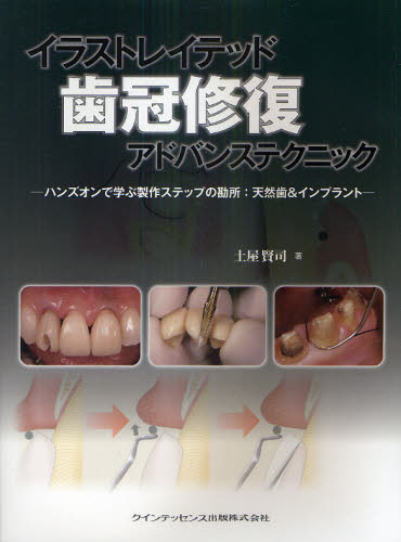 新品即決 イラストレイテッド歯冠修復アドバンステクニック ハンズオンで学ぶ製作ステップの勘所 天然歯 インプラント 内祝い Www Estelarcr Com