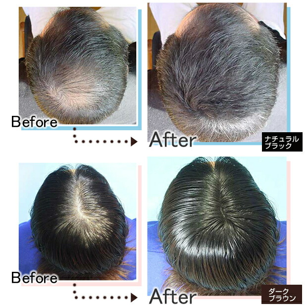 Hairdirect Japan For Thin Hair Hidden Bald Hidden Thin Hair