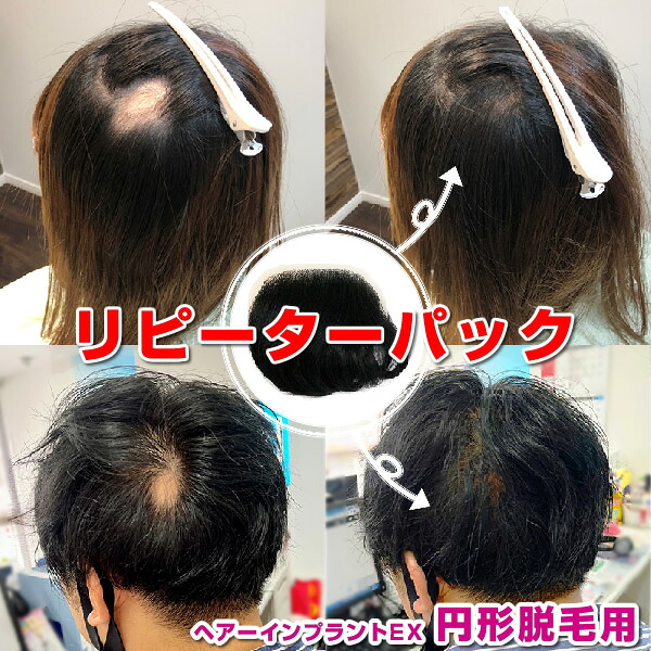 （リピーターパック）ヘアーインプラントEX 円形脱毛症用（部分かつら）※装着にはテープかシリコンのが必要です