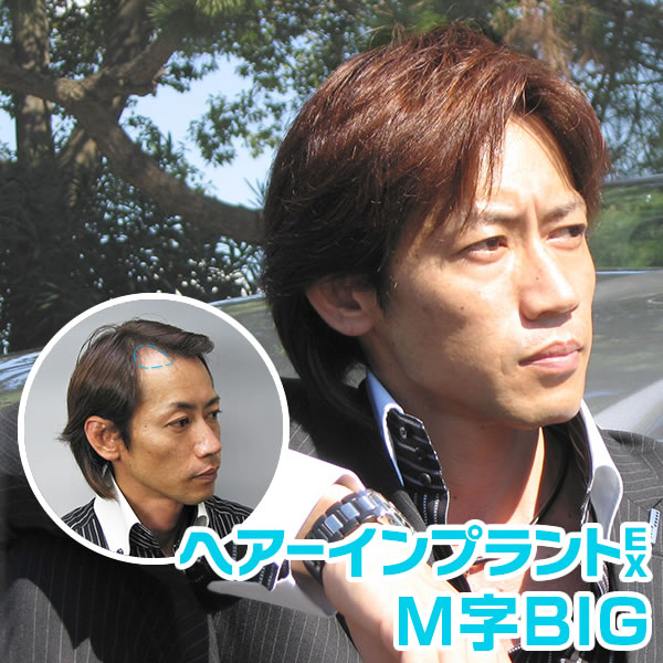 ヘアーインプラントEX M字用BIG(男性用かつら)※強力テープ貼り付け済み