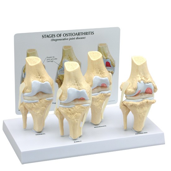 人体模型 膝関節 骨格模型 変形性膝関節症 4段階 OM-GP-1100 GPI Anatomicals 整形外科 患者説明 医学 学習用 教材 送料無料|人体百科 店