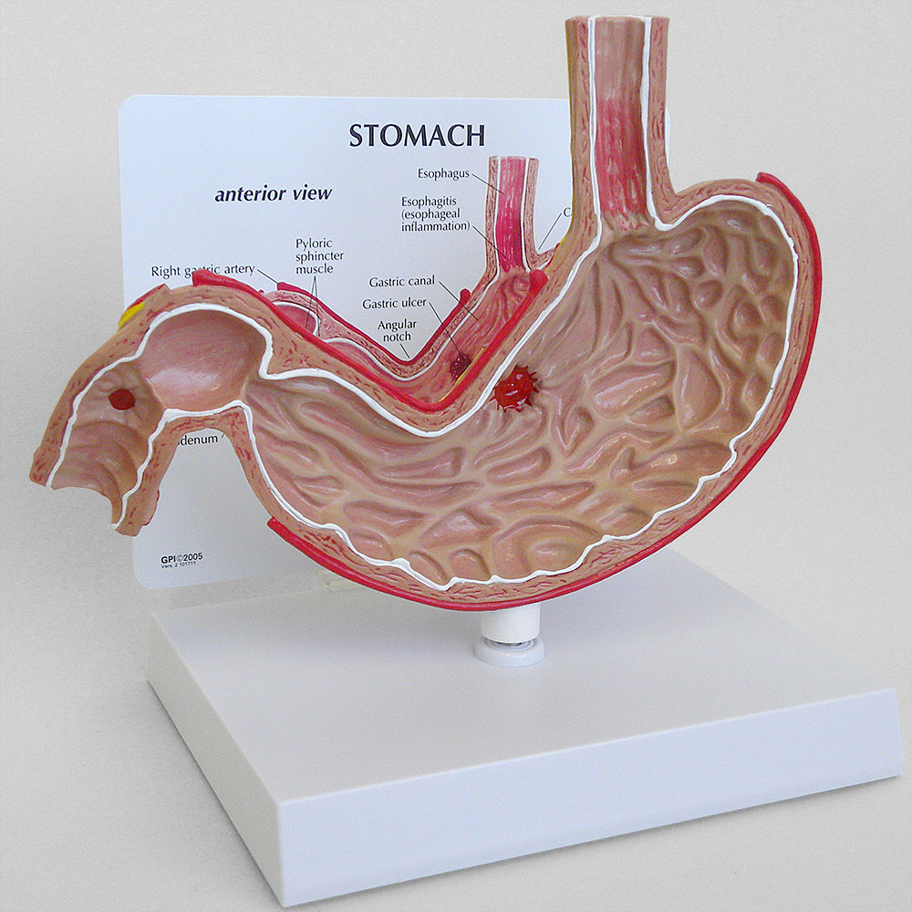 【楽天市場】胃模型 人体模型 潰瘍 OM-GP-2000 GPI Anatomicals 胃潰瘍 十二指腸潰瘍 食道炎 消化器科 患者説明 ...