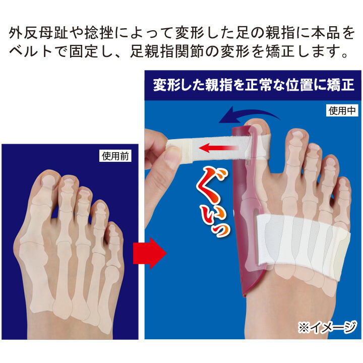 楽天市場 外反母趾矯正プロテクター サポーター 足 足指 外反母趾 変形 親指 矯正 外反母趾ケア 就寝時 サポート 健康 捻挫 左用 右用 ベルト固定 便利雑貨のジャストパートナー