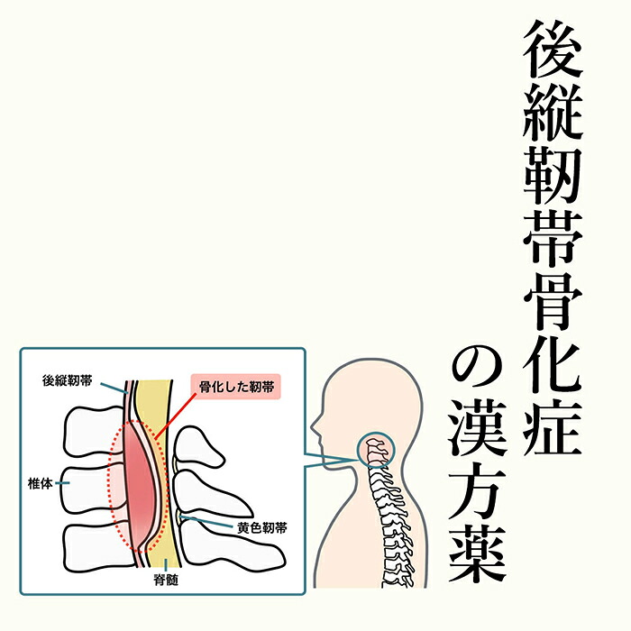 【第2類飲み薬】後縦靱帯骨化症の漢方薬 1日2～4回取り入れる 1か月分 漢方薬 後縦靱帯骨化症 薬 知覚麻痺 手 足 指 漢方 首 腰 お薬 手の知覚麻痺 苦痛なこと 手足の知覚麻痺 知覚麻痺  ・翼血 蝶つがい痛 OPLL 任ずる難病69 電話を掛ける無料話しあい・電子メイル話しあい24第四次元相応う