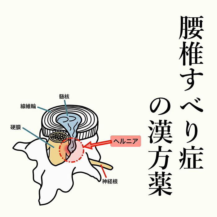 【第2類飲み薬】腰椎すべり症の漢方薬 1日2～4回取り入れる 1か月分 漢方薬 腰椎すべり症 薬 知覚麻痺 手 足 首 腰 お薬 ての知覚麻痺 苦痛なこと 麻黄 当帰 ヨクイニン 名取り草 名取り草 肉桂 手足の知覚麻痺 知覚麻痺 蝶つがい痛 腕力痛 貨物輸送無料 電話を掛ける無料話しあい・電子メイル話しあい24第四次元相応う