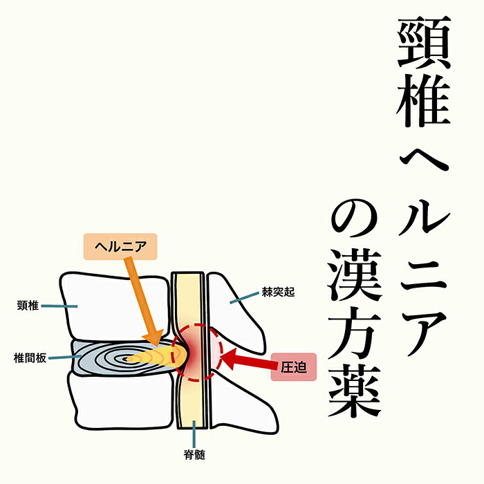 【第2類飲み薬】頚骨脱腸の漢方薬 1日2～4回取り入れる 1か月分 頸椎脱腸 漢方薬 頚骨脱腸 脱腸 漢方 薬 知覚麻痺 手 足 首 腰 お薬 ての知覚麻痺 苦痛なこと 手足の知覚麻痺 知覚麻痺 蝶つがい痛 腕力痛 電話を掛ける無料話しあい・電子メイル話しあい24第四次元相応う