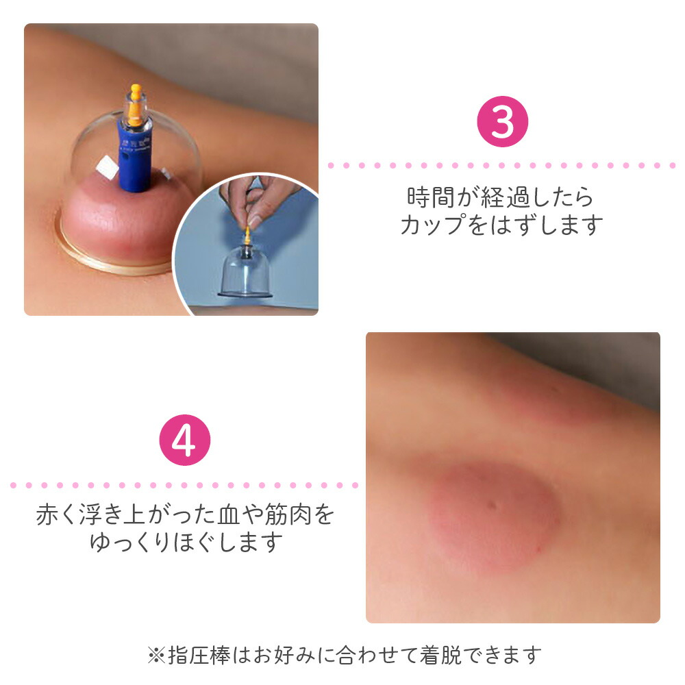 楽天市場 予約販売8 28 カッピング セット 吸い玉 32個セット 6種類 吸玉 吸い玉カッピング 吸玉カッピング 肩こり 腰痛 吸引カップ 送料無料 Yu キラキラハイム