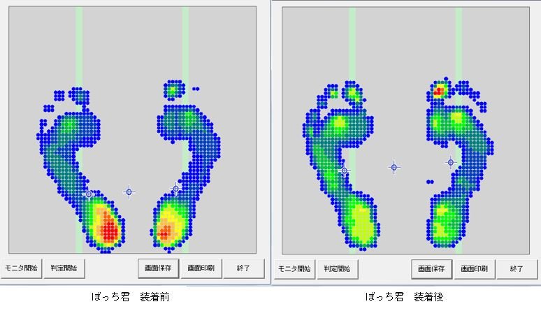 送料無料・選べる4個セット 外反母趾サポーターぼっちくん - 通販