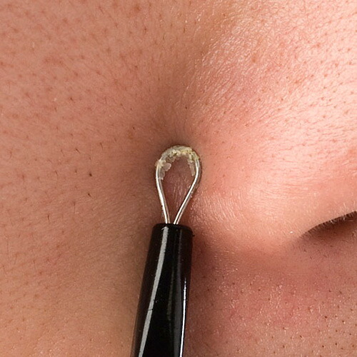 廃番 S 小鼻ケア 毛穴 角栓 メンズスポットステック D 1ページ gランキング