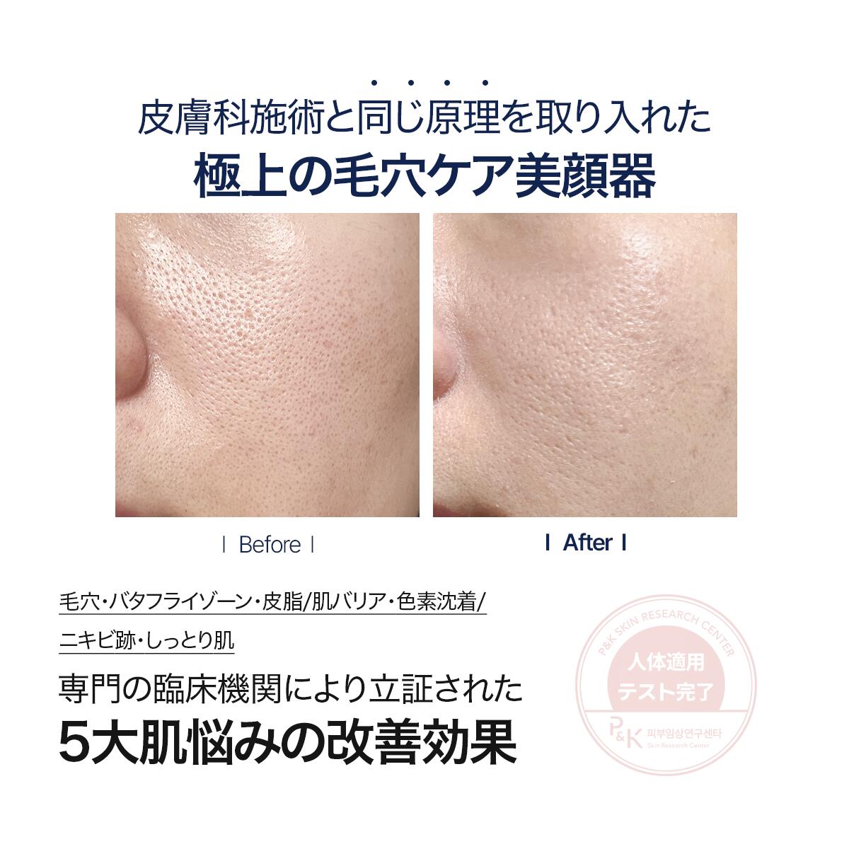 ☆5000円クーポン+毛穴セラム☆ 楽天1位 美顔器 韓国エステ 美容