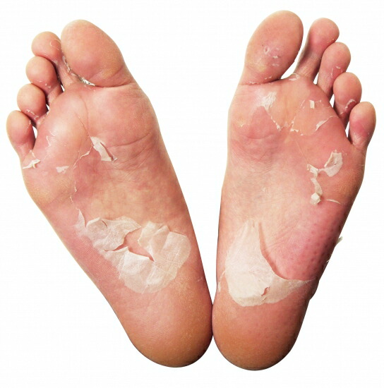 楽天市場 魅せ足コスメプレミアム 美容液 足裏角質ケア 25ml 2枚 ローションパック 角質除去 足 かかと 角質 取り 角質ケア 足裏シート フットケア フットピーリングパック 足裏 角質除去 リラの女王様