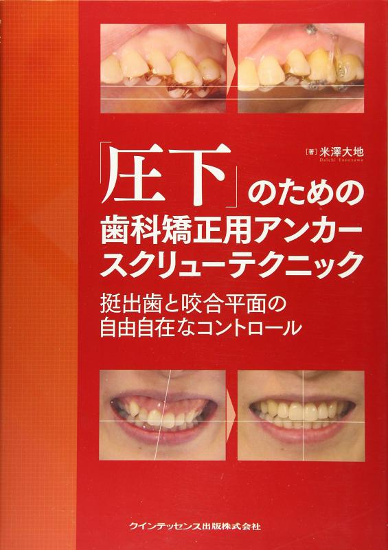 【中古】「圧下」の利益の歯科更生させる用アンカースクリューテクニック 挺出歯と咬合平面の自由自在な抑えつける