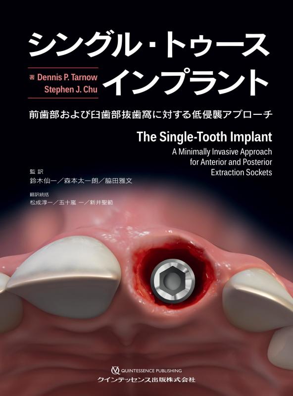 【中古】シングル・トゥースインプラント: 向こう歯部および大臼歯部抜歯窩に対する低異常発生取りかかる