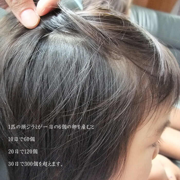これまでで最高の毛じらみ 子供 画像 かわいい子供たちの画像 これまでで最高の毛じらみ 子供 画像 かわいい子供たちの画像
