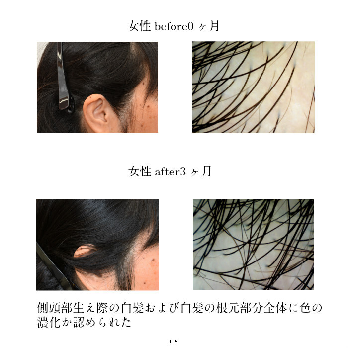 楽天市場 正規販売店 アデランス 美容室専売品 白髪改善 薄毛 頭皮の環境改善 育毛効果 ノンシリコン Bosley ブラックプラスコントロール アデランス シャンプーex1本 コンディショナーex1本 Oly