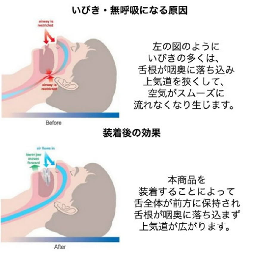 正規代理店 舌用 マウスピース 舌 口呼吸 いびき いびき防止 グッズ 小型 軽量 旅行 安眠グッズ 快眠 不眠 寝具 熟睡tecc Sitapeace Bluebirdsportandspine Ca