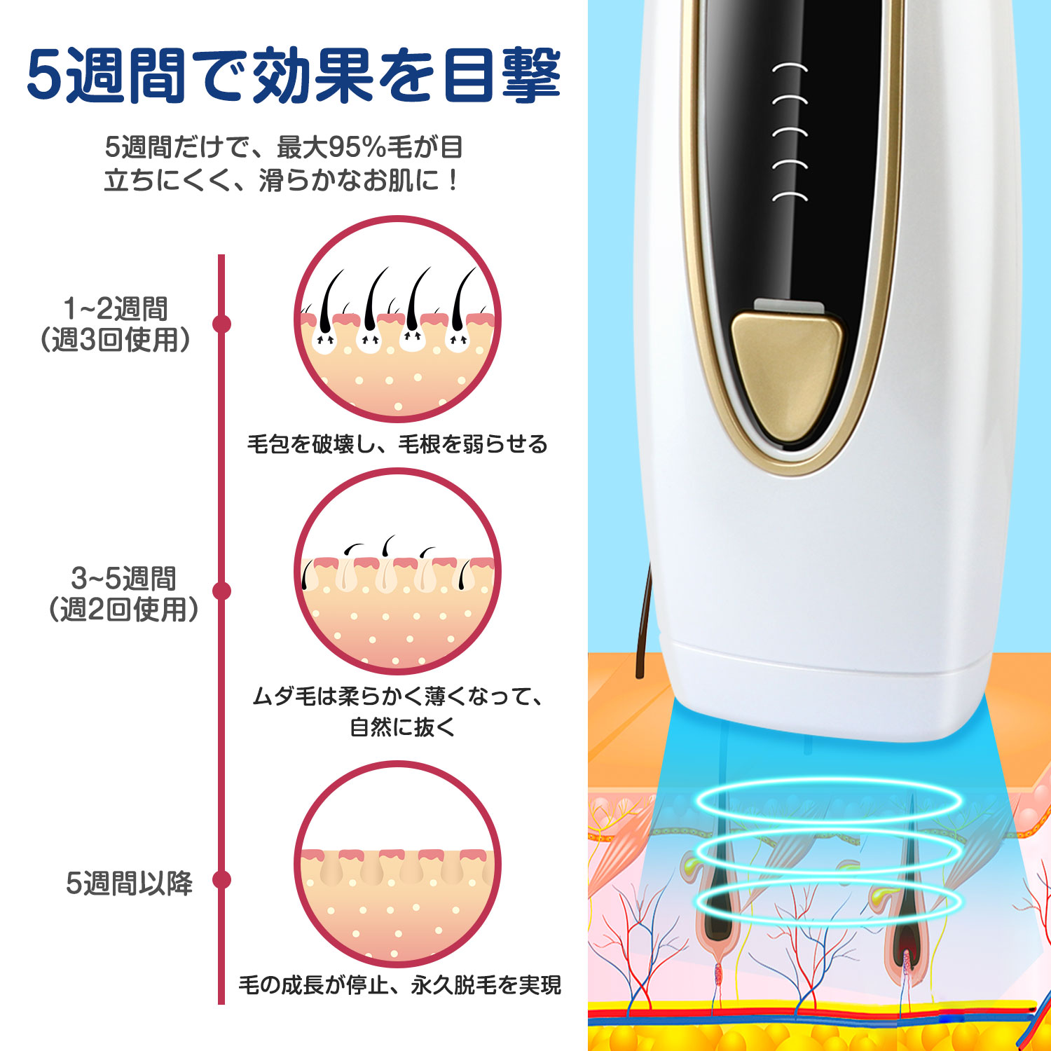 美肌ケア 痛感なし Qzt 脱毛器 無痛 永久脱毛 冷感脱毛 30万照射回数 自動照射 3 3cm 照射面積 5段階調節 冷却クーリング機能 美肌 Ipl光脱毛器 光美容器 顔 背中 Vio 脇 ムダ毛処理 家庭用 全身対応 男女兼用 送料無料 Butlerchimneys Com