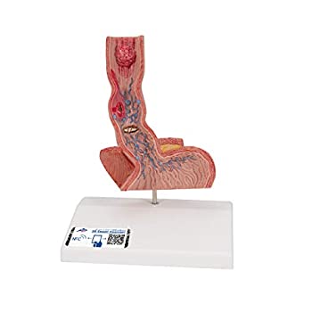 【中古】【輸入品・未使用】3B Scientific K18 Diseases of the Oesophagus Model%ｶﾝﾏ% 14cm x 9.9cm x 19cm